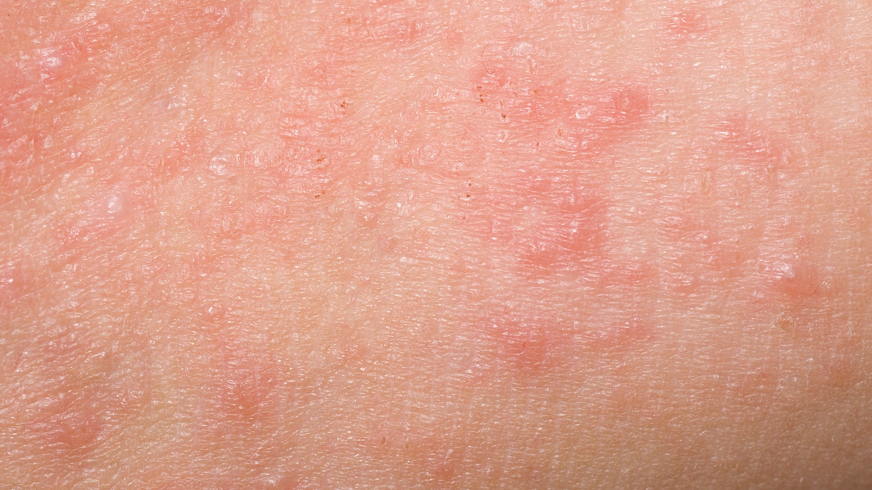 What Is Keratosis Pilaris And Why Does It Look Like Body Acne Huffpost Life