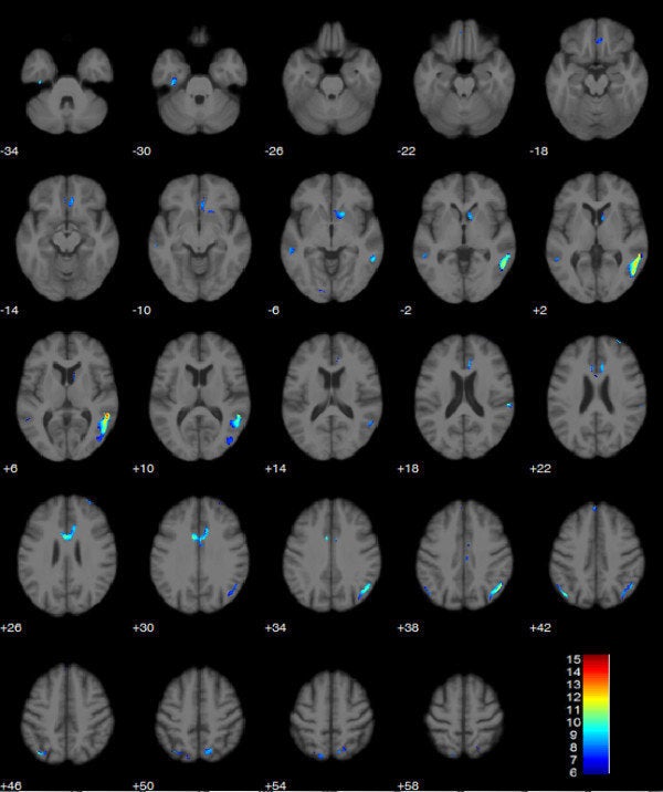 Ultra-marathon runners' brains shrank while racing across Europe