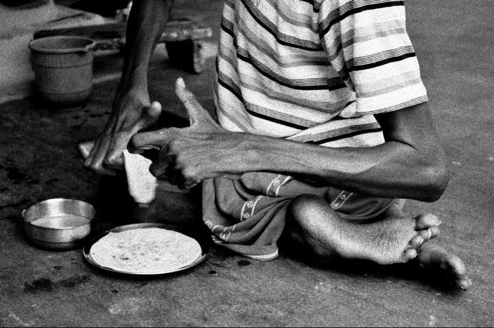 Duniya Oraon, a Jadugoda native, struggles with defects with which he was born.