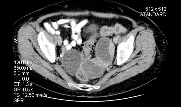 Ovarian cancer.