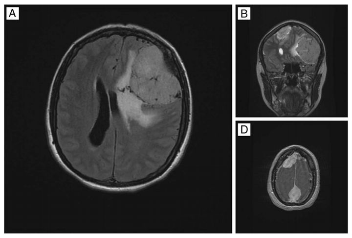 MRIs indicating multiple meningiomas in the patient's brain.