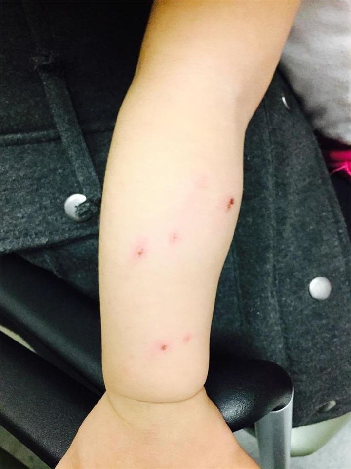 The 17-month-old's arm is seen with multiple abrasions.
