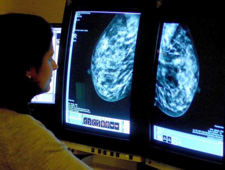 A consultant analyzing a mammogram. Cancer screening has never been shown to save lives in the way that is often claimed, experts have argued.