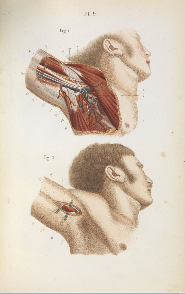 Tying up the armpit's axillary artery, 1848.