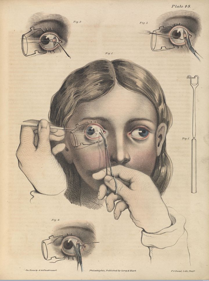 Eye surgery to correct strabismus, a misalignment of the eyes, 1846.