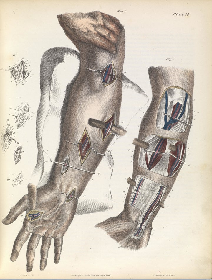 Tying up the arteries of the lower arm, 1846.