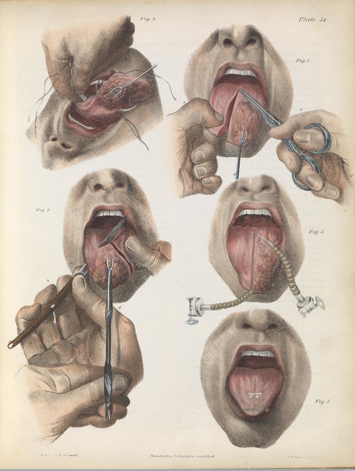 Tongue cancer surgery, 1846.