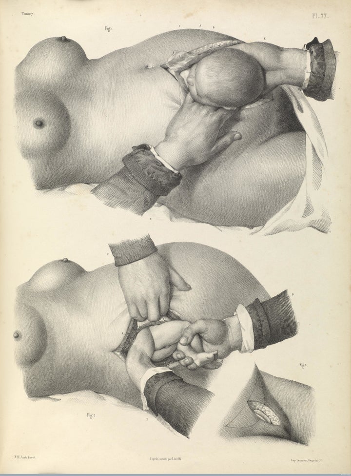 Childbirth by caesarean section,1840 lithograph.