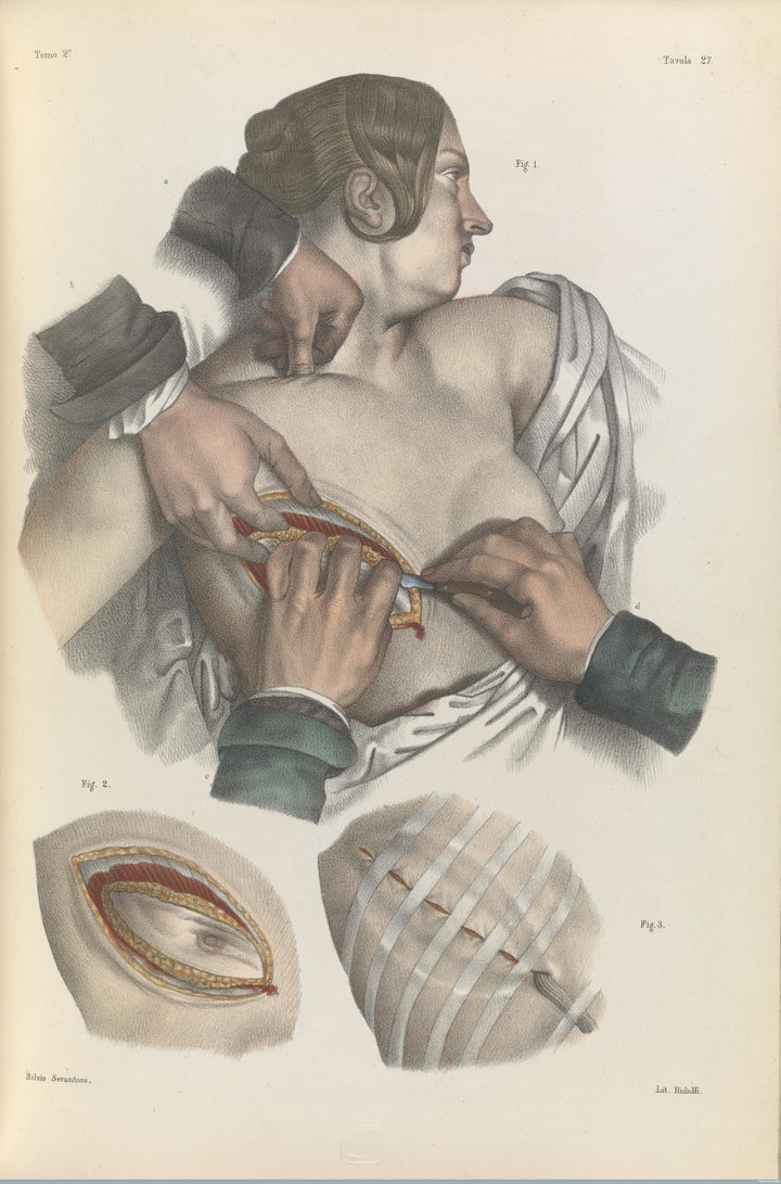 Surgery to remove the breast and dress the wound, 1841.