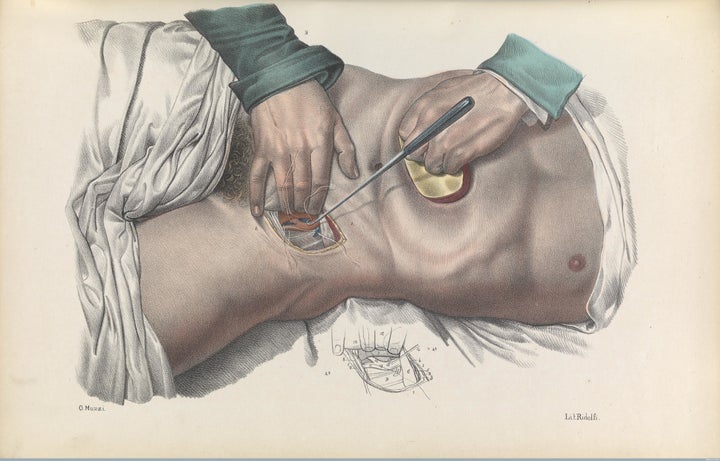 Sewing up an artery in the groin region using sutures and a suture hook, while compressing the abdomen to reduce aortic blood flow, 1841 lithograph.