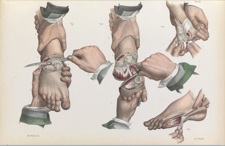 Amputations of the toes and foot, 1841.