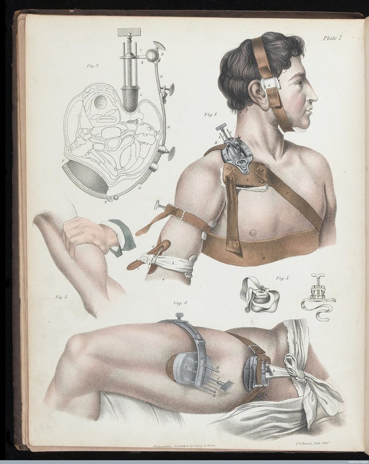 Illustration of operative surgery, 1846.