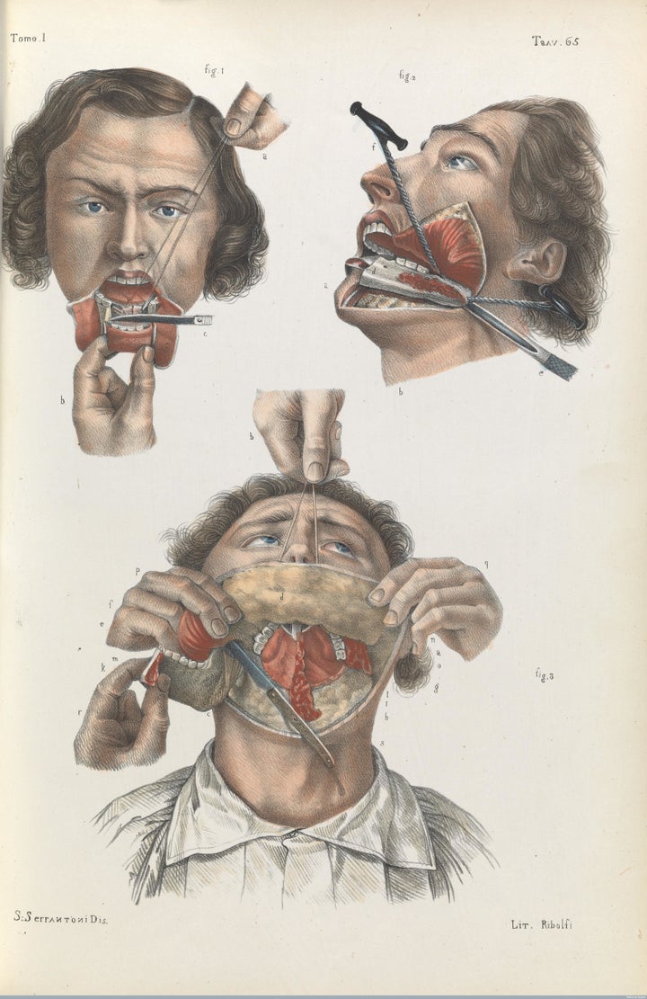 Removal of the lower jaw, 1841.