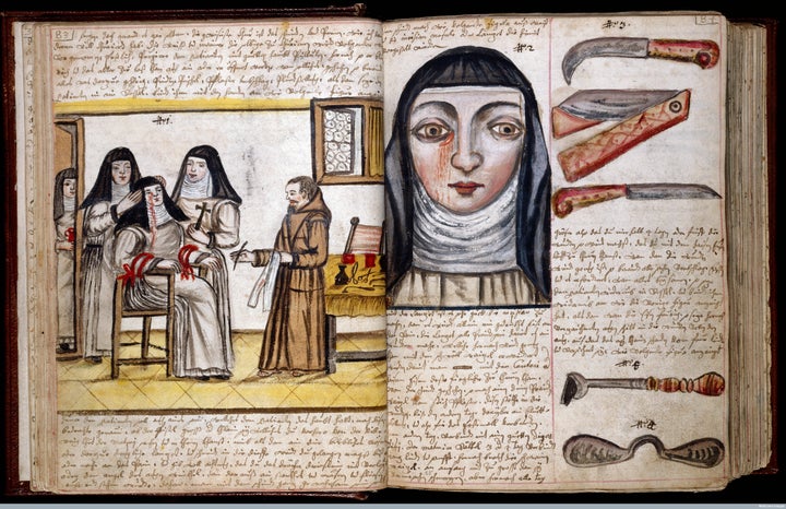 Treatment for lacrimal fistula (a small lesion near the eye), performed on a nun, circa 1675.