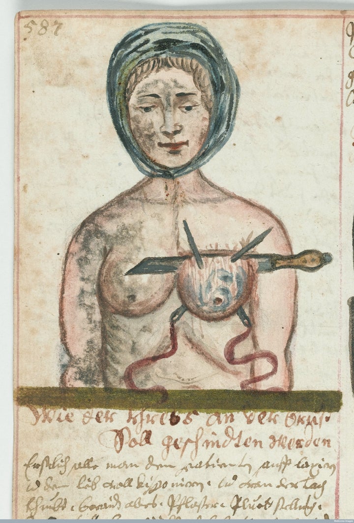 Woman having a breast operation, circa 1675.