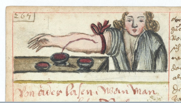 Bloodletting, or withdrawing blood to prevent illness or disease, circa 1675.