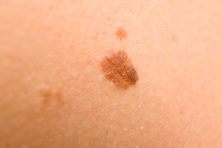 How To Easily Tell If A Skin Condition Is Dangerous Or Not Huffpost