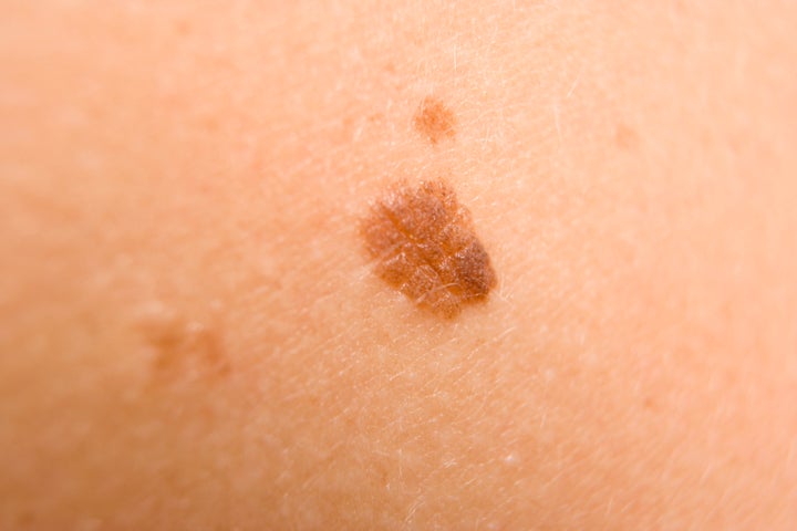 How To Easily Tell If A Skin Condition Is Dangerous Or Not Huffpost