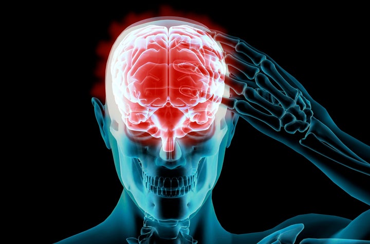 Inflammation in the brain may play an important role in the development of Alzheimer's.
