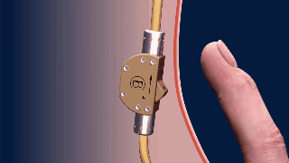 The Bimek SLV, a device for reversible male contraception, is supposed to work through a switch that can be flipped through the skin of the scrotum.