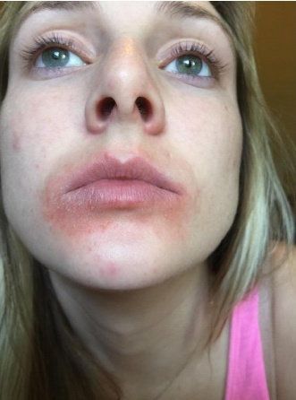 Rachel Cronan's skin reaction after using EOS lip balm.