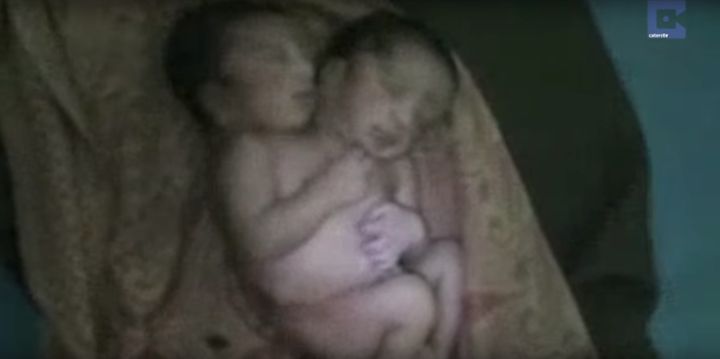 These conjoined twins born in northern India were dubbed a "miracle baby" by locals.