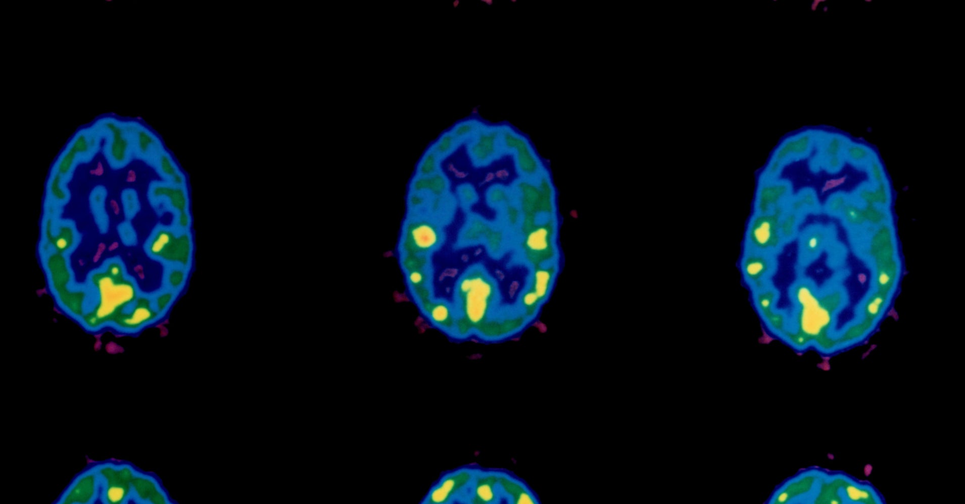 Cocaine Causes Your Brain To Literally Eat Itself, Study Finds HuffPost