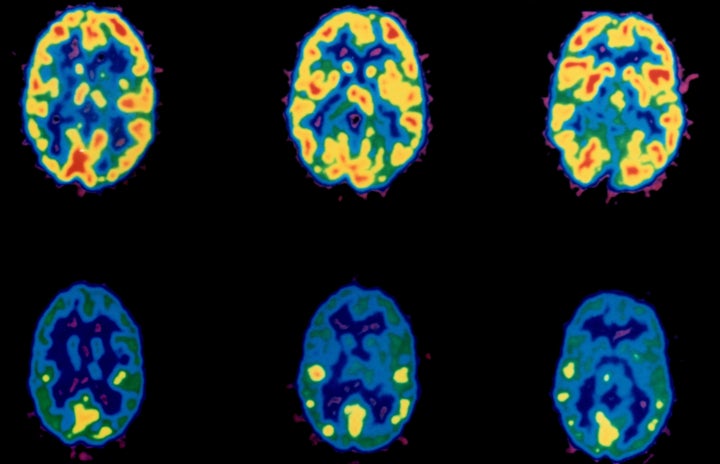 A look at brain activity during cocaine use.