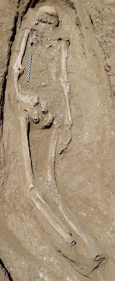 Man with an obsidian bladelet embedded into the left side of his skull, and a projectile lesion (possibly of a sharpened arrow shaft) on the right side of the skull.