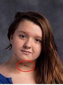 Nicole's tracheotomy scar is circled in this photo released by police.