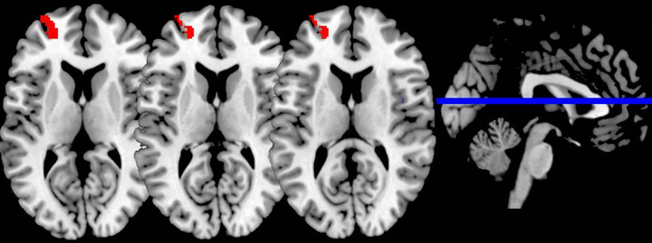 Brain scans show increased functional connectivity in the brain after a mindfulness meditation retreat.