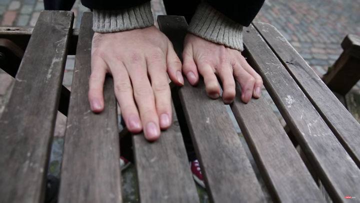 Richard Stott, 28, shows the results of a surgery that replaced two of his fingers on his left hand with his toes.