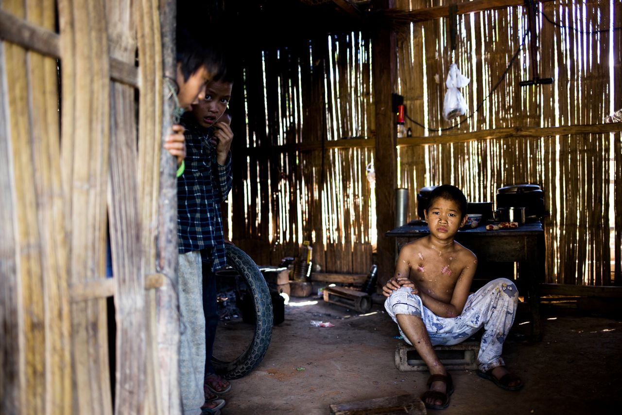 Luo Ben Qing, 10, and his two young cousins were severely injured in a landmine blast near their home in Mengbo village in October. In this photo, one of Ben Qing's injured cousins, 10-year-old Ben Cing, is seen sitting in his home. According to the boy, he was carrying a bag in front of his body on the day of the incident. The bag, he says, may have saved his life.