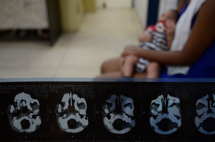 RECIFE, BRAZIL - FEBRUARY 01: Detail of X-Rays of João Heitor baby born with microcephaly at Oswaldo Cruz Hospital on February 1, 2016 in Recife, Brazil.