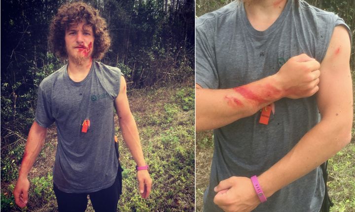 The New Jersey landscaper is seen showing off his battle wounds after wrestling a 13-footer.