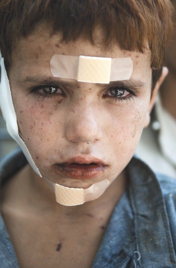 Jalid, an Afghan child wounded by NATO bombs.