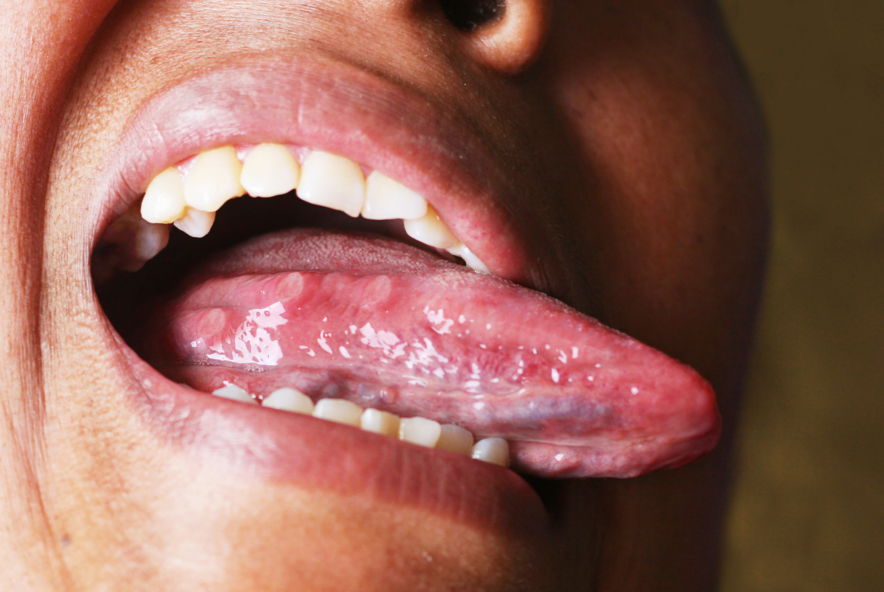 What Your Tongue And Tonsils Could Tell You About Your Sleeping Habits 