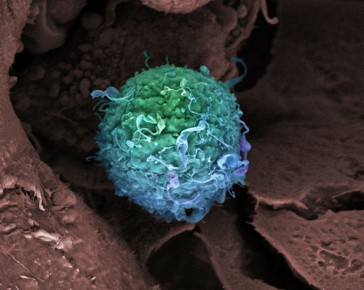 Breast cancer cells 