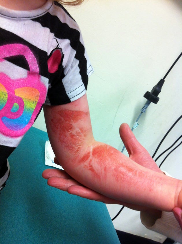 Shocking Photos Show Girl's Injuries After Aeroplane Airbag Exploded