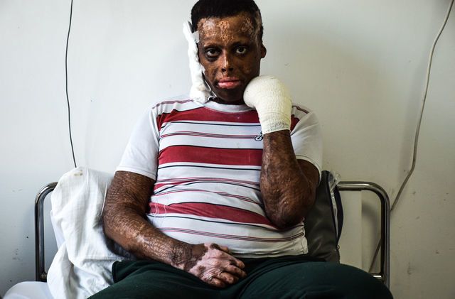 Wael Samir al-Shouafi, from Yemen, is undergoing treatment at the Mowasah Reconstructive Hospital to heal the burns that cover most of his body.