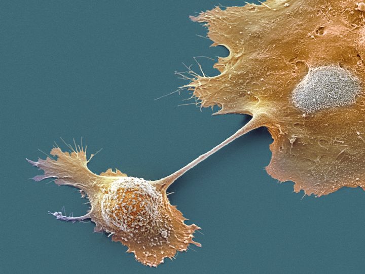 Pancreatic cancer cells.