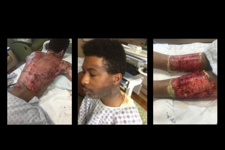 Marquez Tolbert suffered second and third-degree burns after the alleged Feb. 12 attack. 