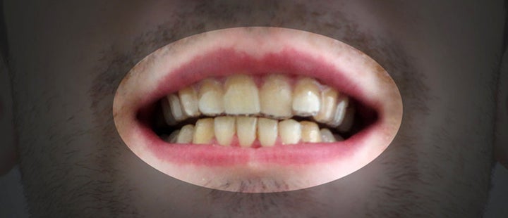 Dudley's teeth before wearing his DIY braces.
