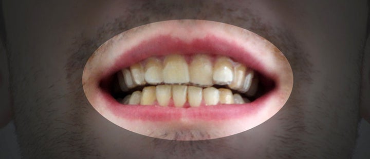 Dudley's teeth before wearing his DIY braces. 