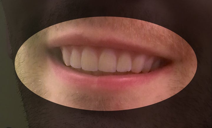 Dudley's teeth, as a result of his own 3-D printed braces.