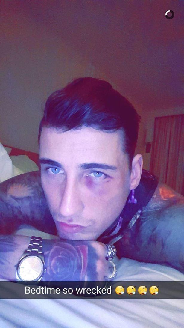 Jeremy McConnell shared this image of his black eye on Snapchat