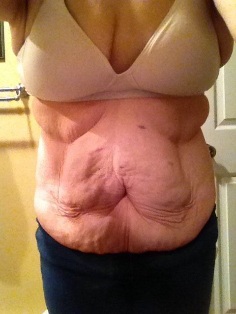 Mary's excess skin after losing weight.