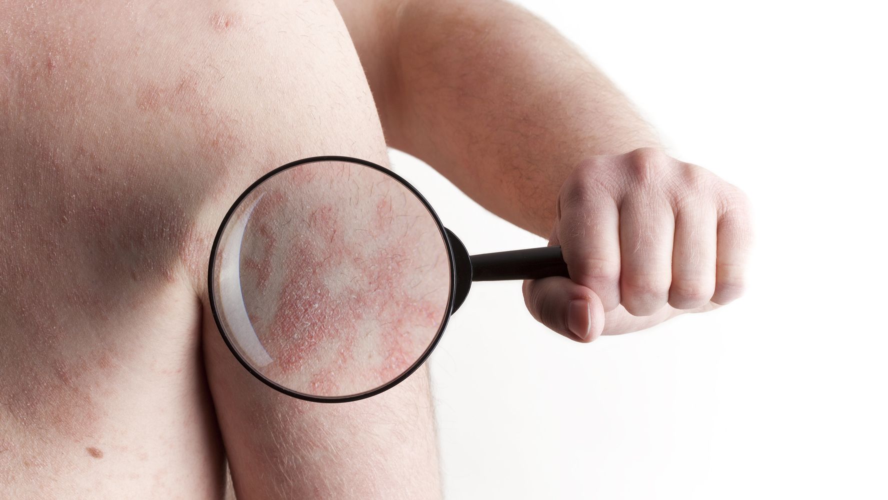 Men With Psoriasis Could Be More Likely To Have This Sexual