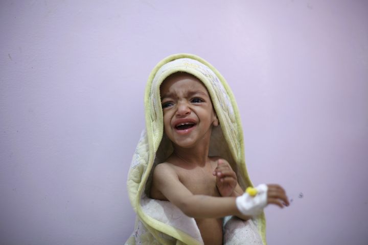 A malnourished boy cries as he sits on a bed at a malnutrition intensive care unit in Yemen's capital on Feb. 10, 2016. Six Yemeni children have been killed or wounded each day since the conflict escalated last March.