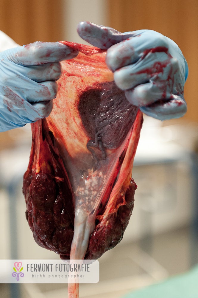 A midwife holding the membrane up to show where the baby has been living for the past nine months